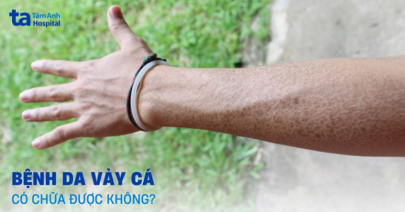 bệnh vẩy cá có chữa được không