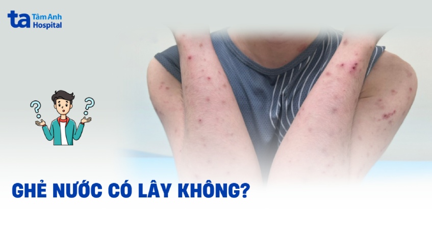 bệnh ghẻ nước có lây không