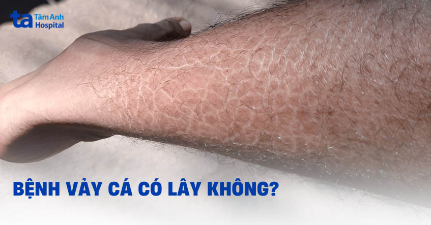 Bệnh vảy cá có lây không