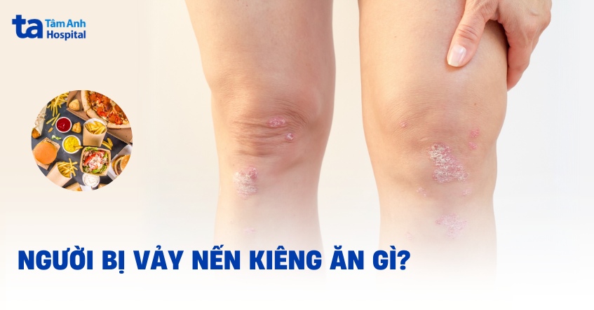 bị vảy nến kiêng ăn gì