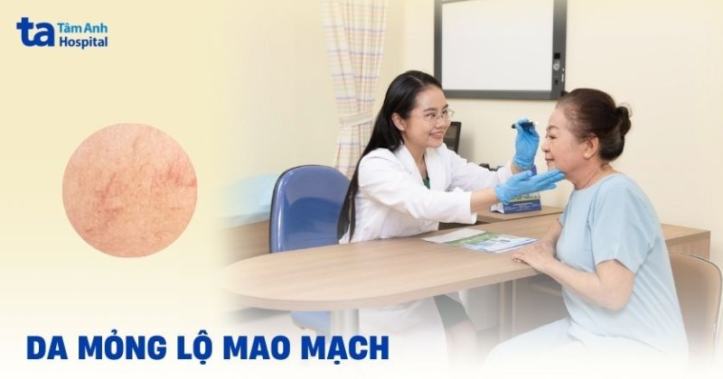 da mỏng lộ mao mạch