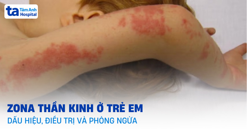 zona thần kinh ở trẻ em