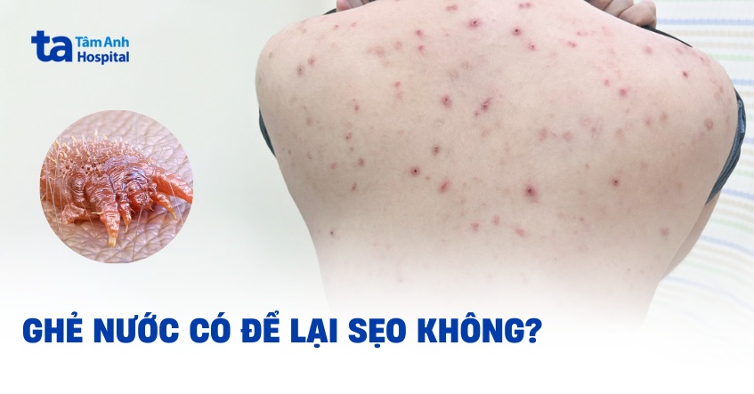 ghẻ nước có để lại sẹo không
