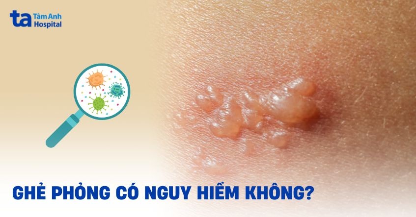 ghẻ phỏng có nguy hiểm không