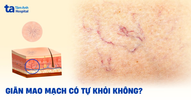 giãn mao mạch có tự khỏi không