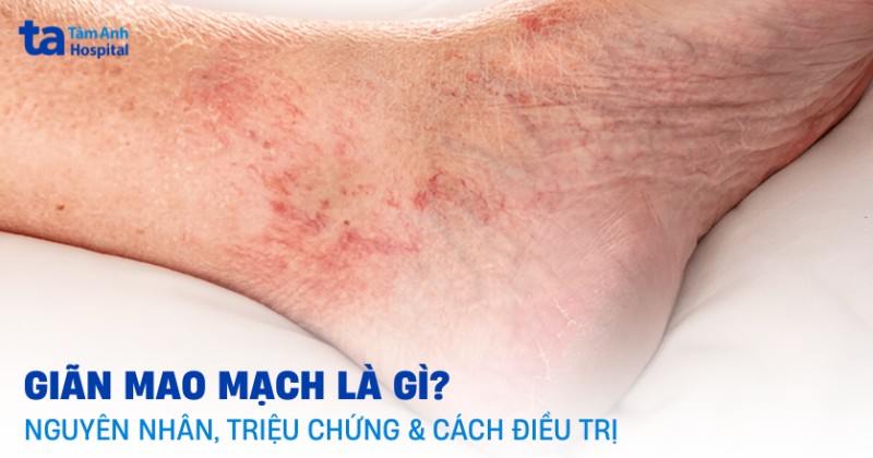 giãn mao mạch