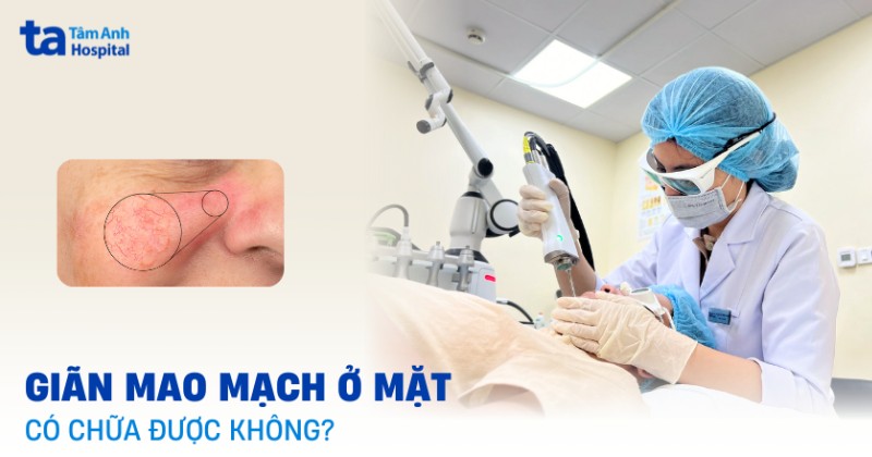 giãn mao mạch ở mặt có chữa được không