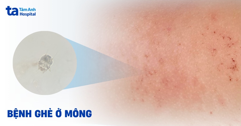 bị nổi ghẻ ở mông