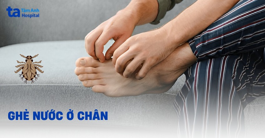 ghẻ nước ở chân