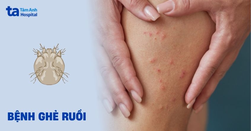 ghẻ ruồi là bệnh gì