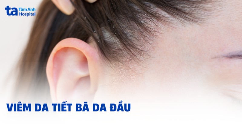 viêm da tiết bã da đầu