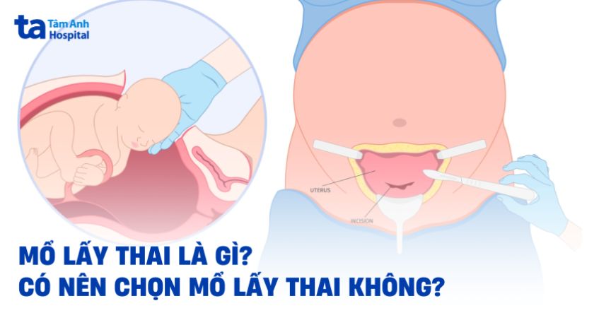 Mổ lấy thai là gì