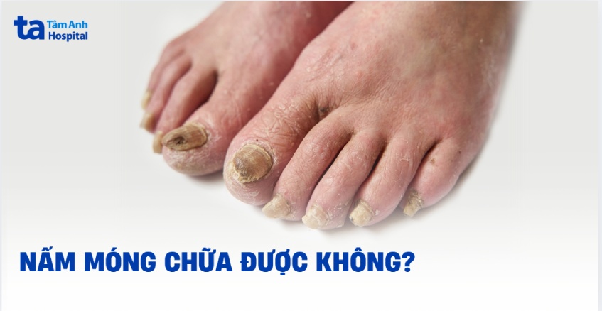 nấm móng có chữa được không