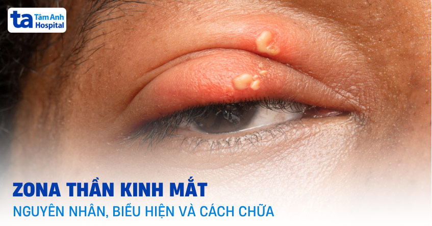 zona thần kinh ở mắt