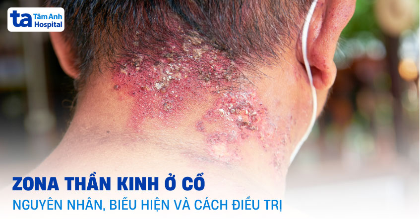 zona thần kinh ở cổ
