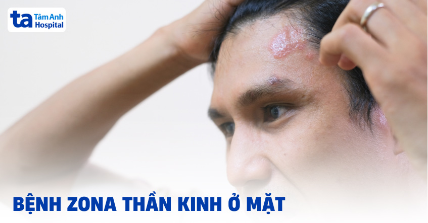 bệnh zona thần kinh ở mặt