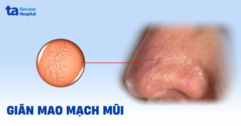 giãn mao mạch mũi