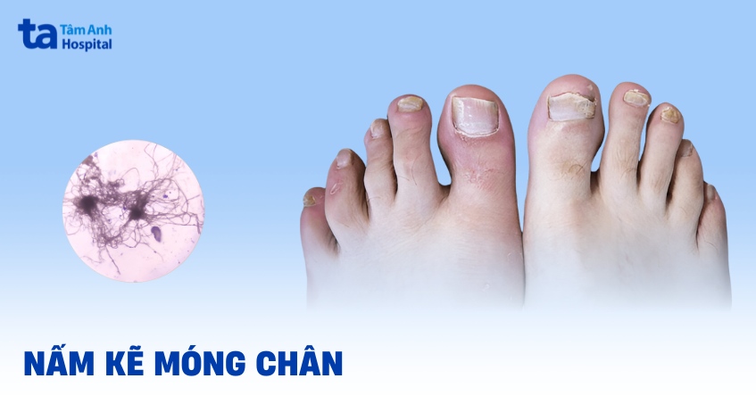 nấm kẽ móng chân