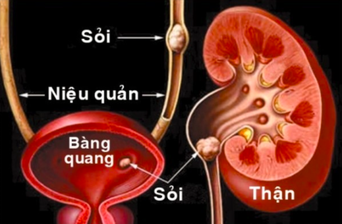 Sỏi tiết niệu gây nhiều biến chứng nếu không xử lý sớm. Ảnh: Bệnh viện cung cấp