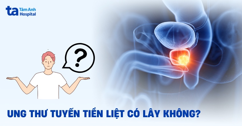 ung thư tuyến tiền liệt có lây không