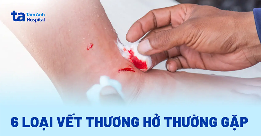6 loại vết thương hở thường gặp