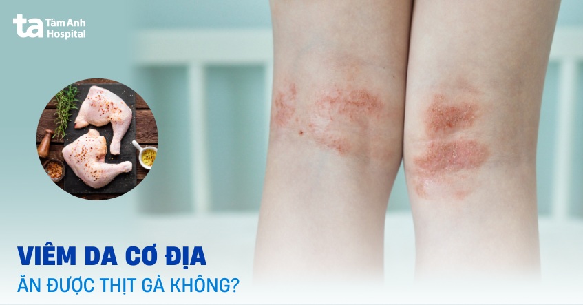 viêm da cơ địa có ăn được thịt gà không