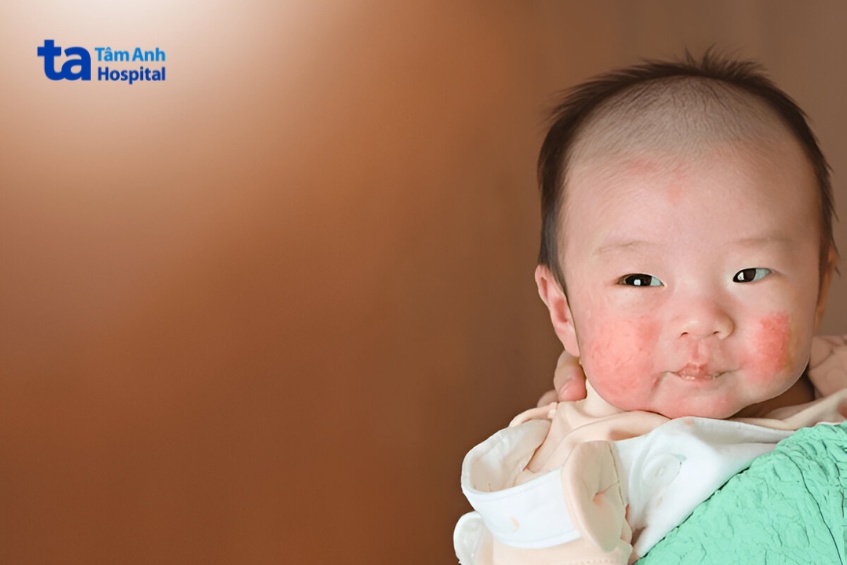 dấu hiệu viêm da cơ địa ở mặt