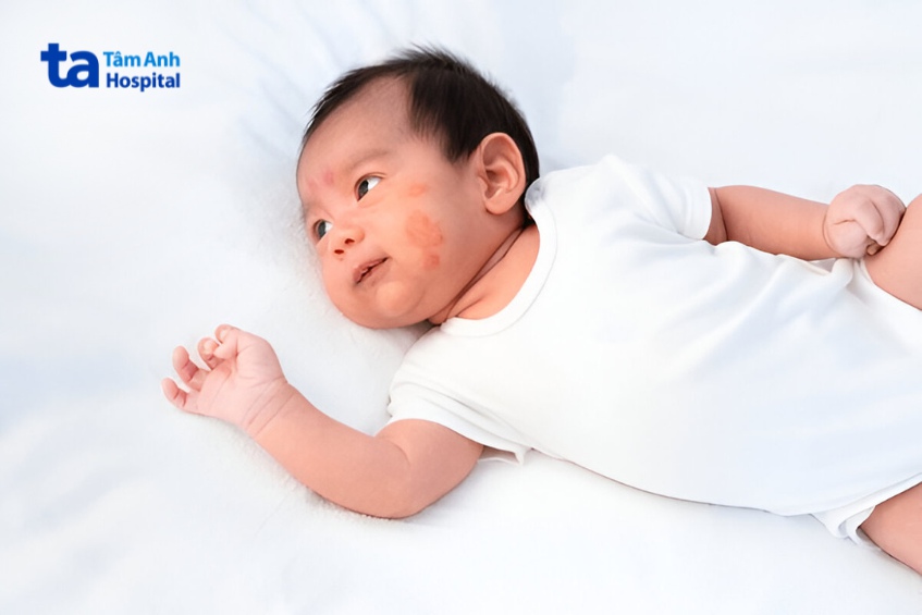 hình ảnh viêm da cơ địa mặt ở trẻ em