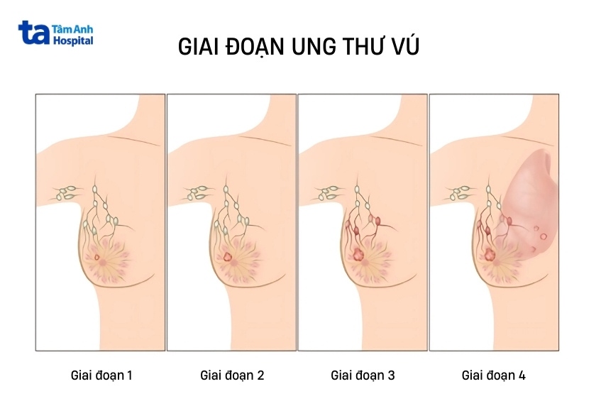 minh họa 4 giai đoạn ung thư vú