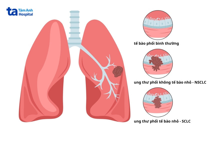 ung thư phổi không tế bào nhỏ phổ biến