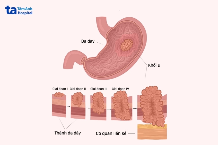 đánh giá 4 giai đoạn ung thư dạ dày