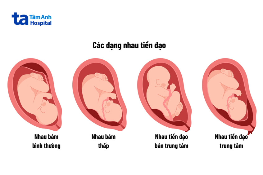 vị trí của bánh nhau thai