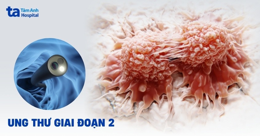 ung thư giai đoạn 2