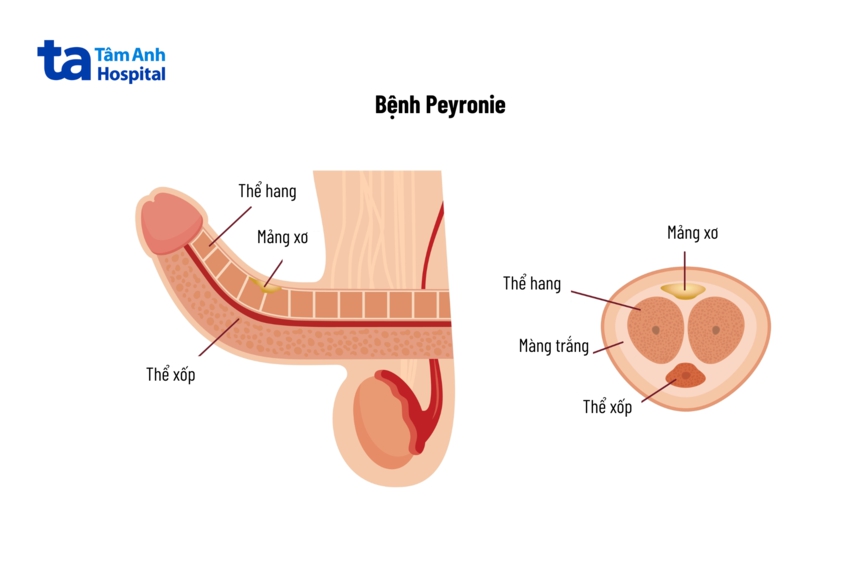bệnh peyronie hình thành các mảng mô sẹo bám dọc theo dương vật
