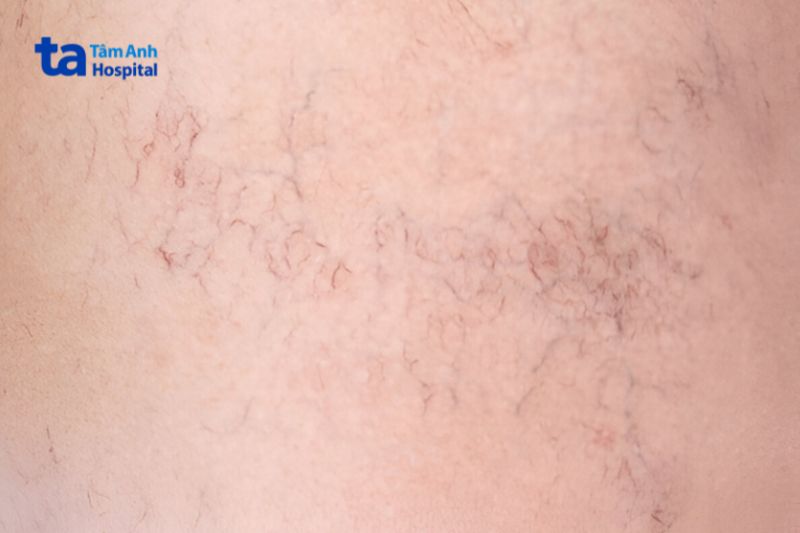 giãn mao mạch là hiện tượng mạch máu giãn râ