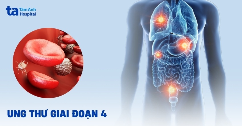 ung thư giai đoạn 4