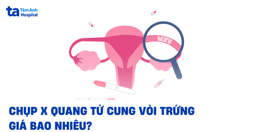 chụp x quang tử cung vòi trứng giá bao nhiêu