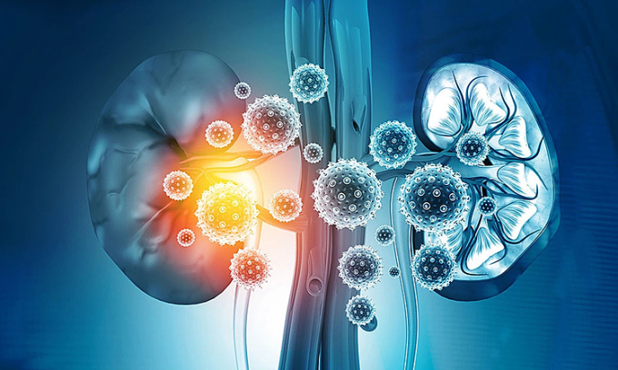 Minh họa tình trạng suy thận. Ảnh: Preferred Vascular Group