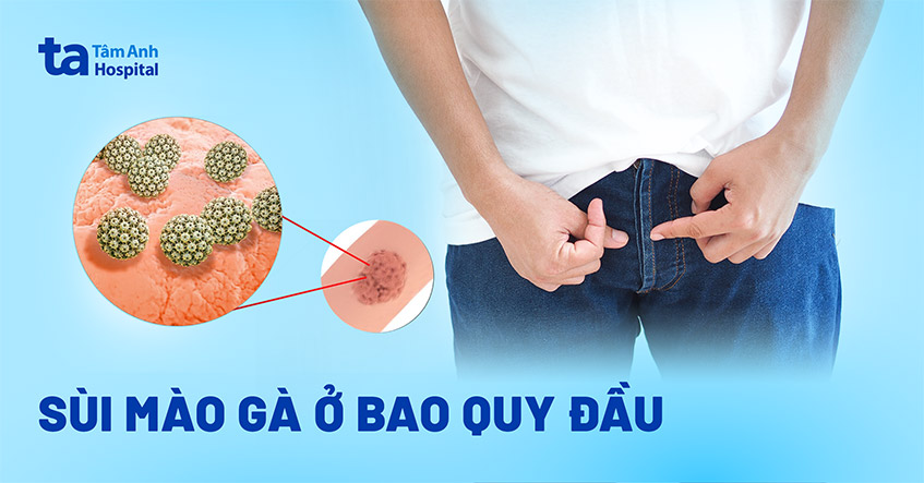 sùi mào gà ở bao quy đầu