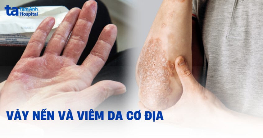 vảy nến có phải viêm da cơ địa không