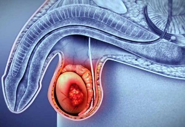Nhận biết triệu chứng qua các giai đoạn của ung thư tinh hoàn