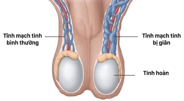 Giãn tĩnh mạch thừng tinh